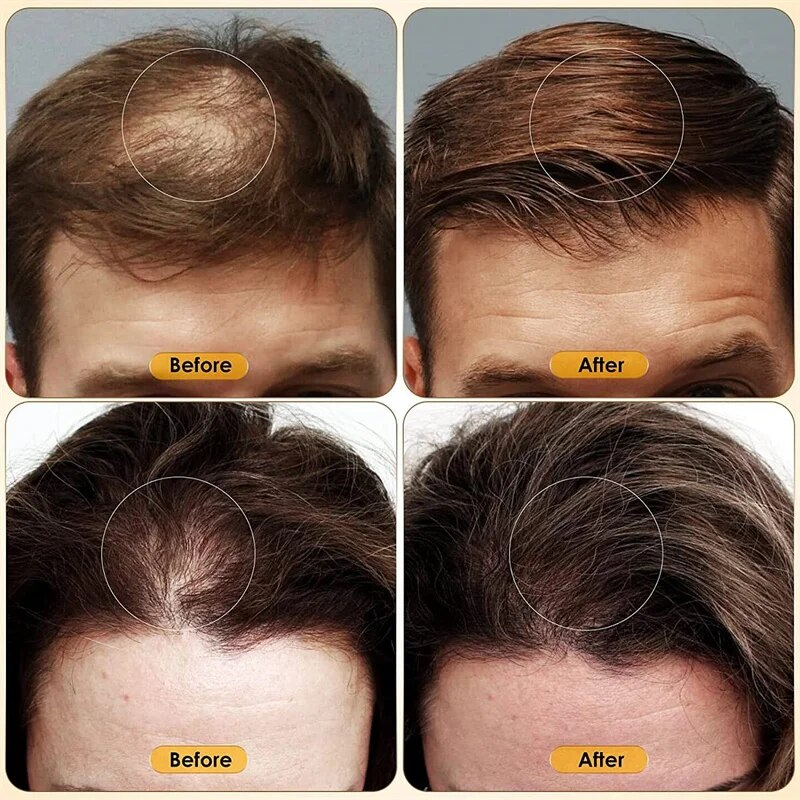 Ginger Fast Hair Growth Serum Spray Regrowth Essence Oil Hiustenlähtöä estävät tuotteet ehkäisevät kaljuuntumista Päänahan hoito Kauneus terveys_voghion.com