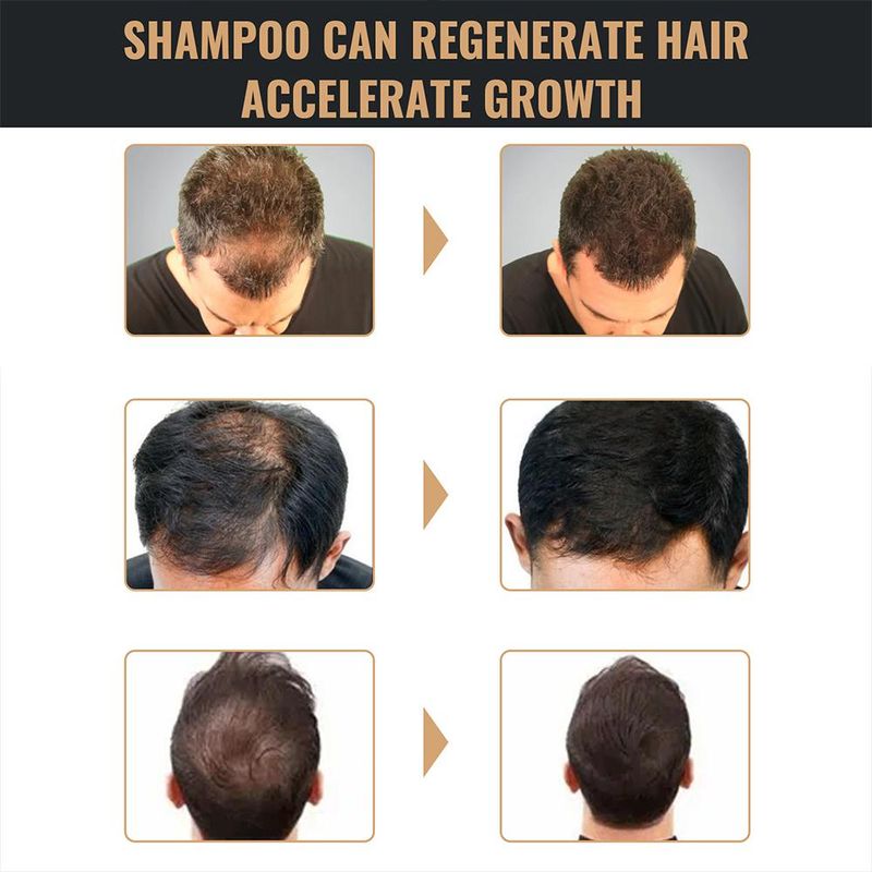 2PCS Anti-Haarausfall-Shampoo, Verdickungsshampoo, Wurzelaktivator-Shampoo, nährendes Haarwachstums-Shampoo für dünner werdendes Haar und Haarausfall_voghion.com