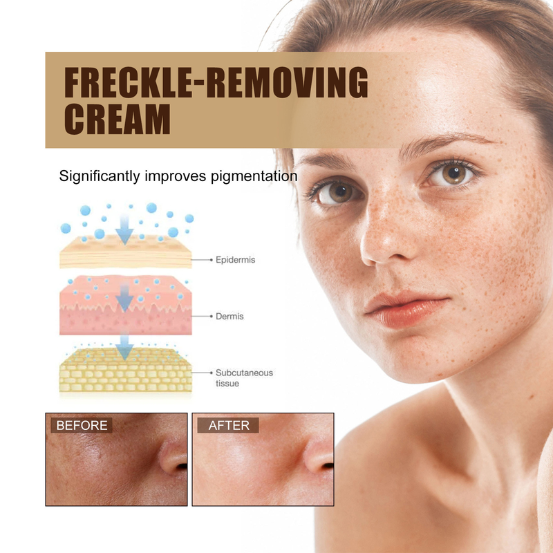 Cream Beautiful Freckle Moisturizes and Moisturizes Freckles, Blackspots, Yellowish Brown Spots, and Melanin Whitening s,_voghion.com