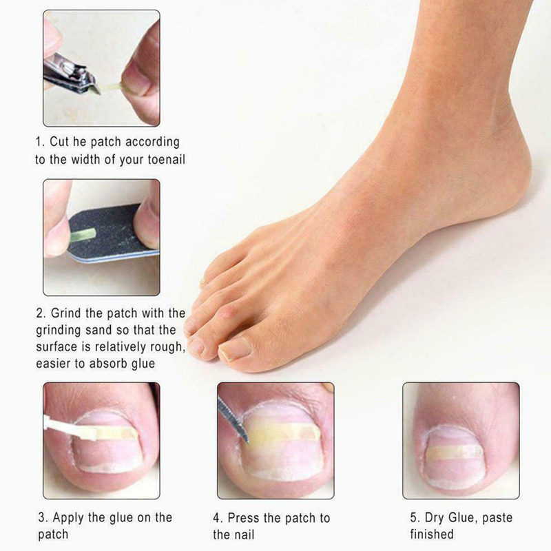 10 pièces/ensemble ongle incarné pince à redresser Patch élastique pince à redresser orthèse incurvée ongles Correction élastique autocollant_voghion.com