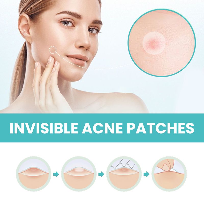 West&Month Acne Patch (300pcs) Repairs Acne And Blackheads, Cleans Pores, Is Invisible, Breathable, Concealer And Waterproof_voghion.com