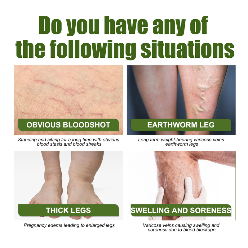 EELHOE slimming vein patch relieves swelling of veins, leg muscles, earthworm legs, body discomfort and body shaping patch_voghion.com