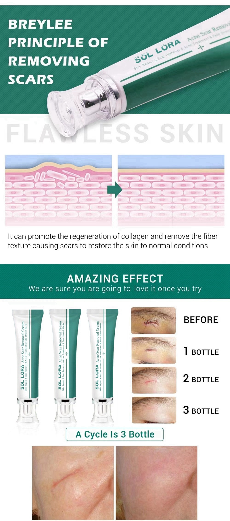 SOL LORA Crema Riparatrice per la Desalinizzazione e la Rimozione dell'Iperplasia delle Cicatrici da Acne nelle Ferite da Taglio Cesareo_voghion.com