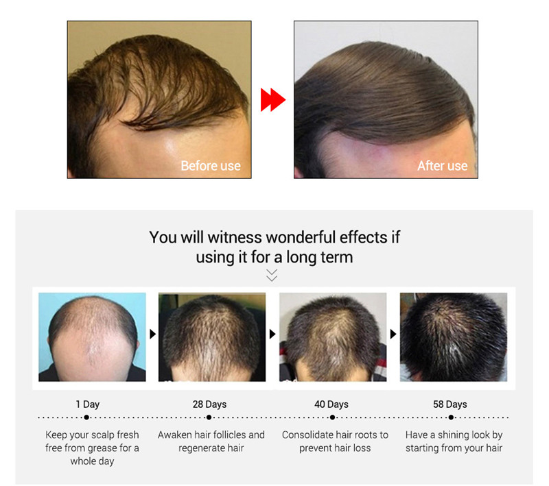 Okeny's Fast Powerful Hair Growth Essence Products Αιθέριο έλαιο Υγρό Θεραπεία Πρόληψης Τριχόπτωσης Περιποίηση μαλλιών Andrea 20ml_voghion.com