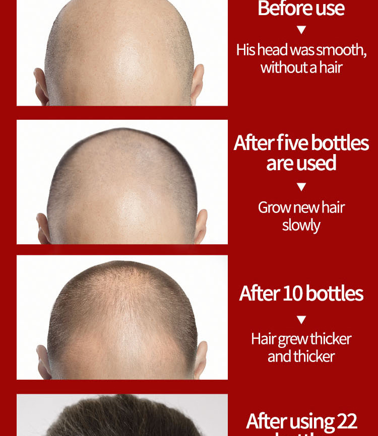 Biotin Fast 2023 Hoer Wuesstem Ueleg Hoer Wuesstem Serum Hoer Ausdünnung Behandlung Hoer Wuesstem Flëssegket Anti-Hoer Verloscht_voghion.com