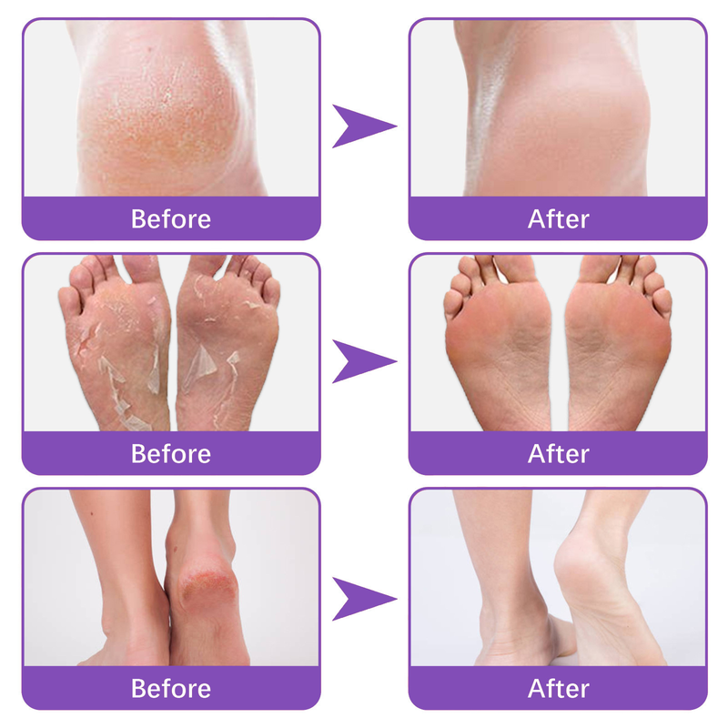Mascarilla de jengibre para pies secos y agrietados, exfoliante y eliminador de piel muerta, hidratante y nutritiva._voghion.com