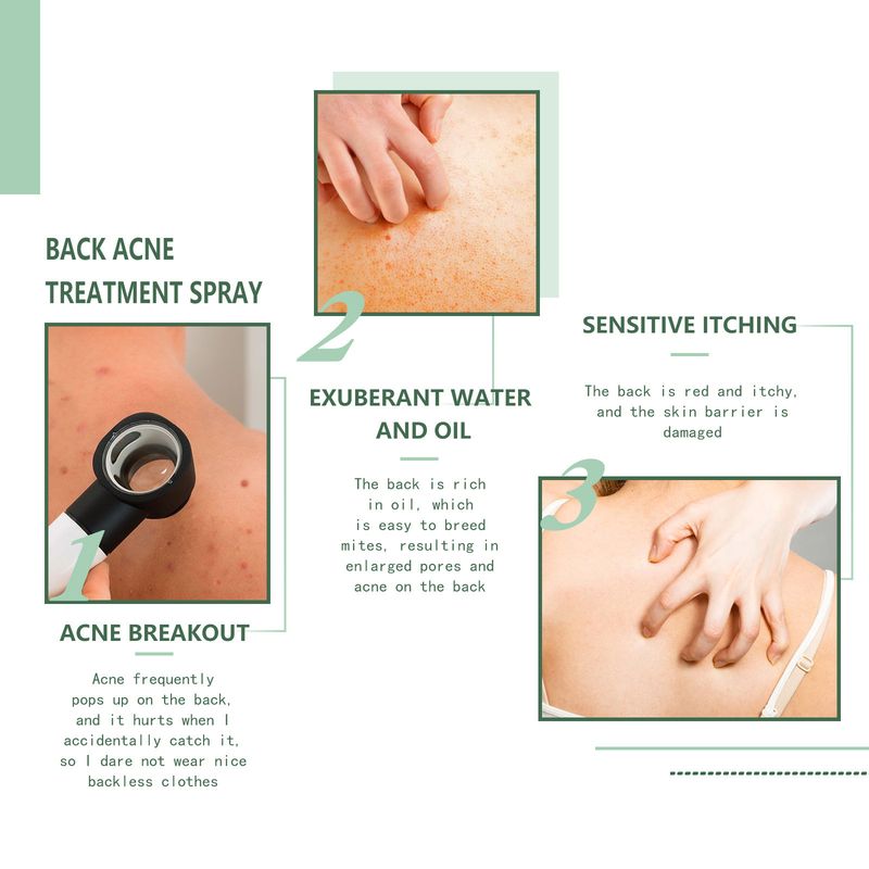 EELHOE djuprengörande kropp rygg och armar bleknar akne märke hud skönhet fuktgivande spray_voghion.com