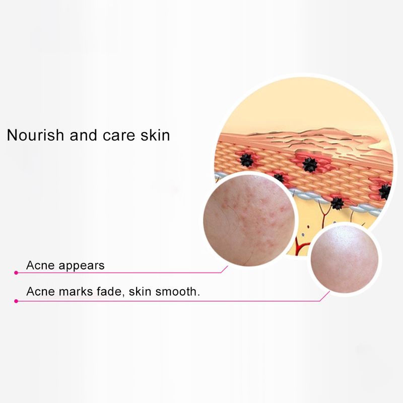 30 g Acne Comedo Pimples noņemšanas poru samazinošs mitrinošs ādas kopšanas krēms_voghion.com