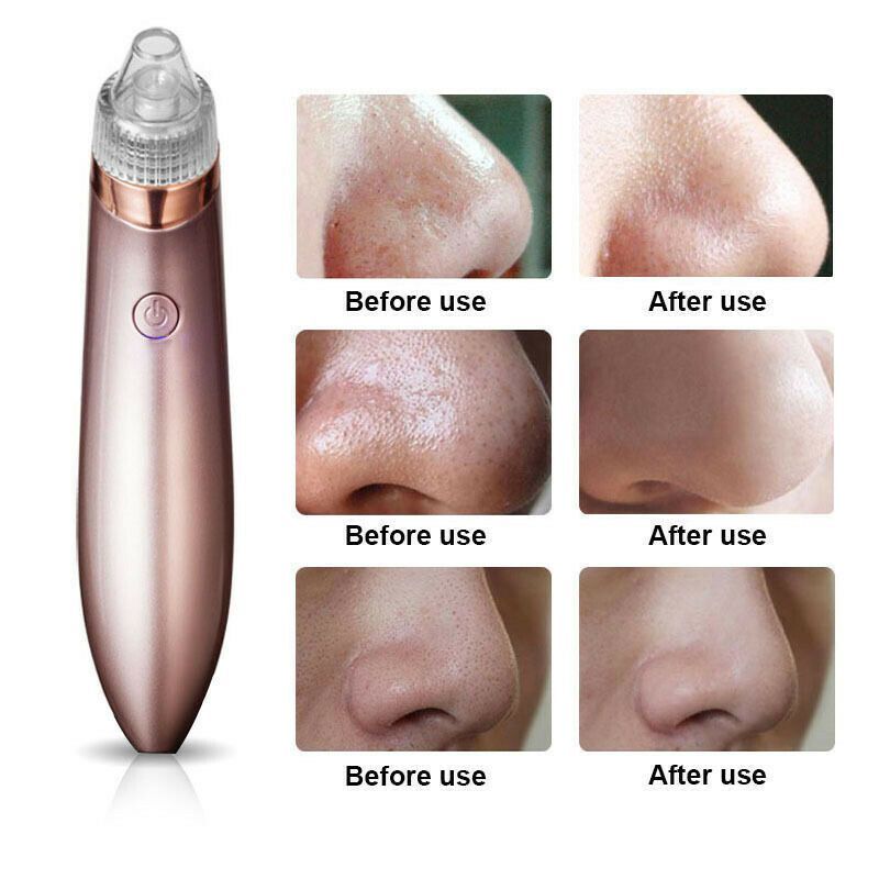Aspirateur électrique pour points noirs, nettoyeur de pores, élimine les boutons d'acné, outil d'aspiration puissant, élimine les points noirs, aspiration sous vide des pores, dermabrasion au diamant F_voghion.com