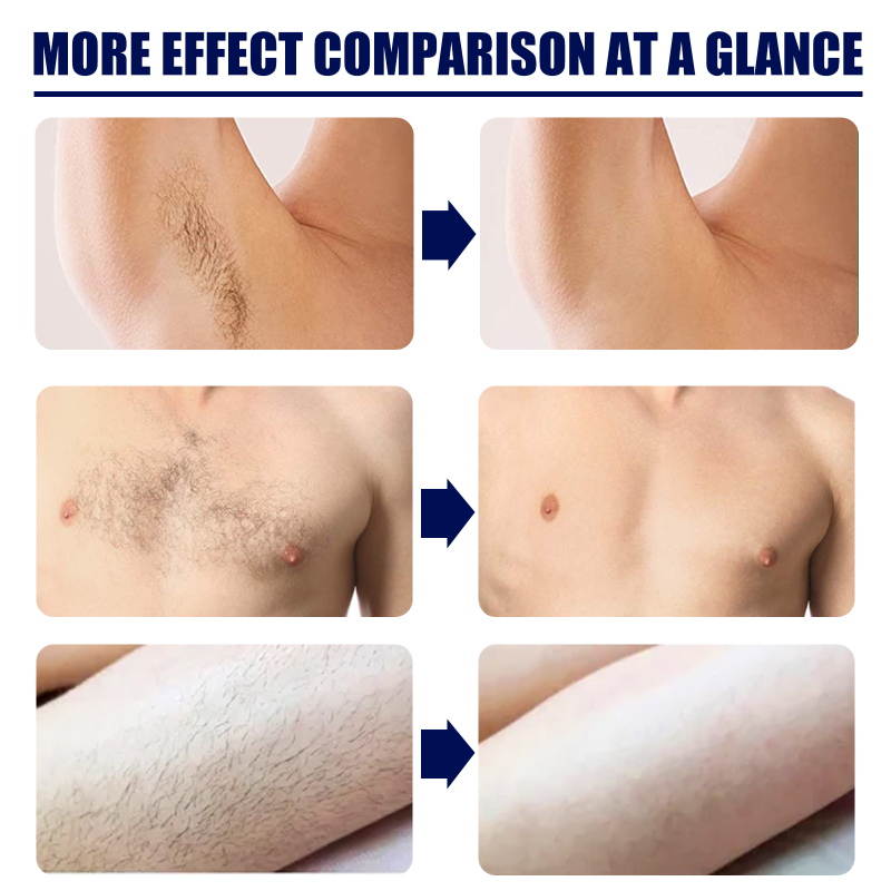 Inhibitor Hårfjerningscreme Permanent Hårgenvækst Inhibitor Smertefri til skæg Bikini Intim Ben Krops Armhule_voghion.com