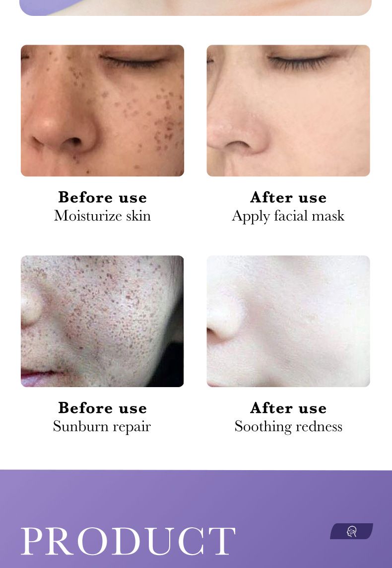 SADOER Niacinamide Whitening And Freckle Removal Mask 25ml Single Piece Hydrating And Moisturizing Serum_voghion.com
