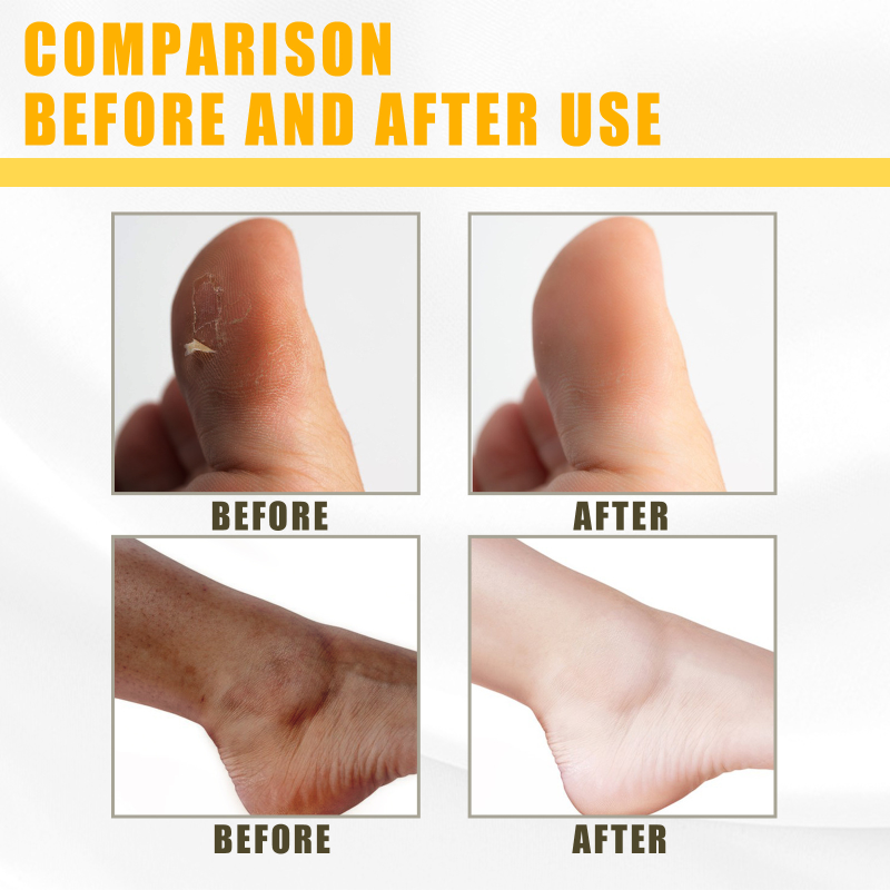 Giel Peeling Ueleg Däischter Haut Bleechung Ewechzehuelen Aarm Knéi Been Melanin Kierper Peeling Brightening Whitening Beauty S_voghion.com