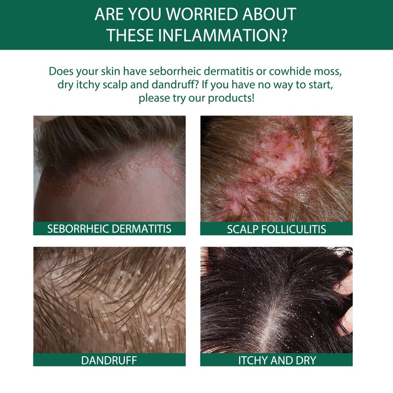 EELHOE Scalp Serum, Deep Cleansing Follicle Dandruff Repair Hair Smoothing Treatment Essence_voghion.com