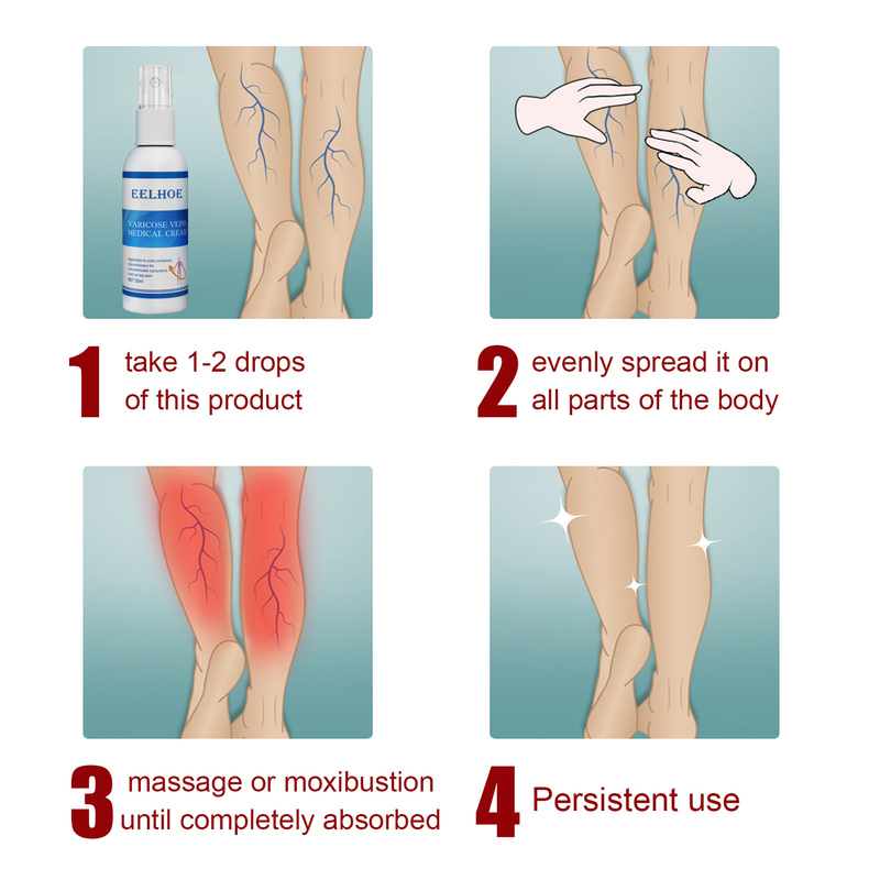 massaggio Bella vena spray varicoso allevia la venatura, leviga la gamba del lombrico, allevia il dolore del protubo vascolare della gamba_voghion.com