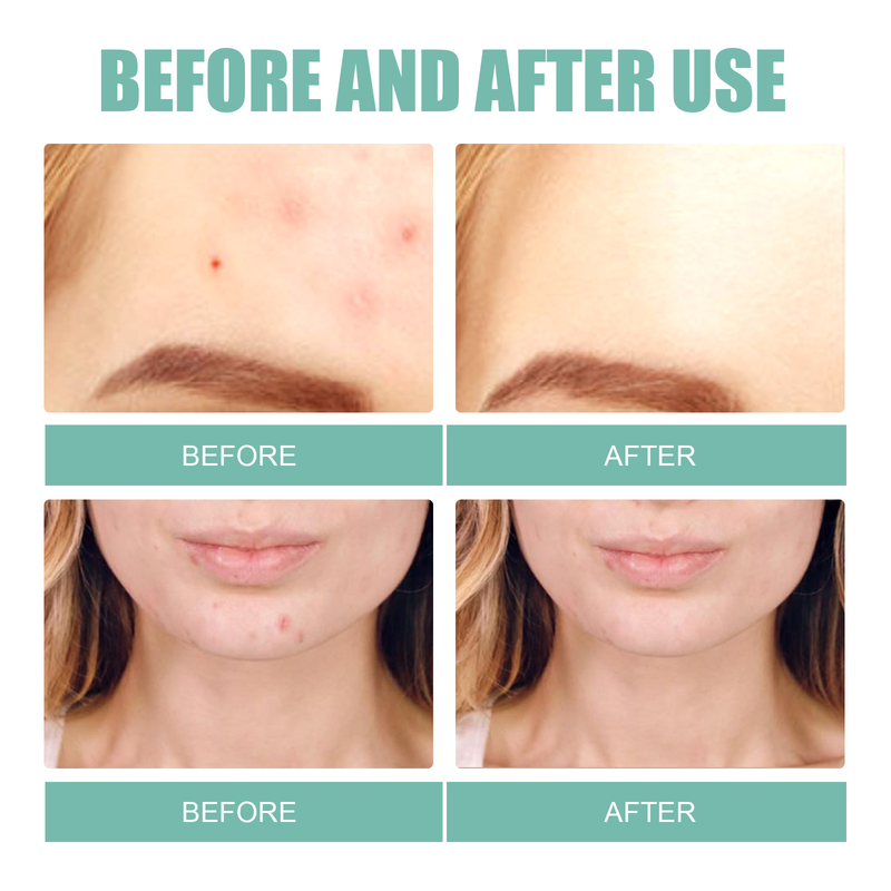 EELHOE Acne Removing Facial Mask Patch Mild and Non Irritating Fade Acne Marks, Acne Patch, Acne Healing Facial Repair Patch_voghion.com