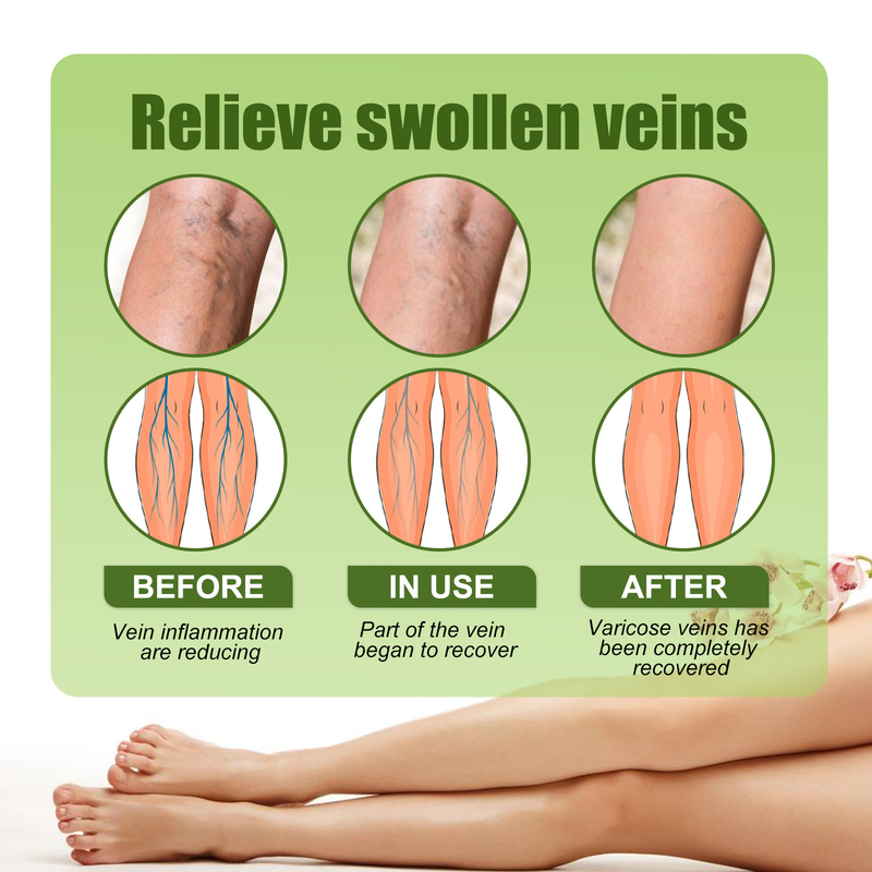 EELHOE slimming vein patch relieves swelling of veins, leg muscles, earthworm legs, body discomfort and body shaping patch_voghion.com