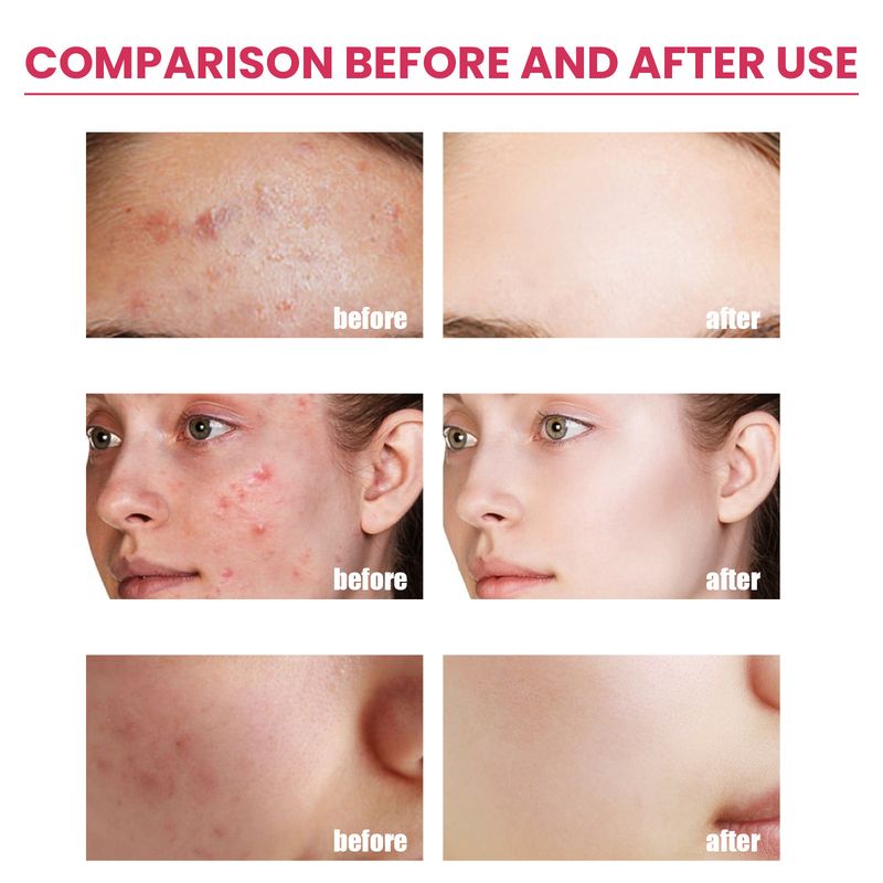 EELHOE Pore Repair Cream Lighten Acne Marks aging Moisturizing Whitening Skin Anti wrinkle face cream_voghion.com
