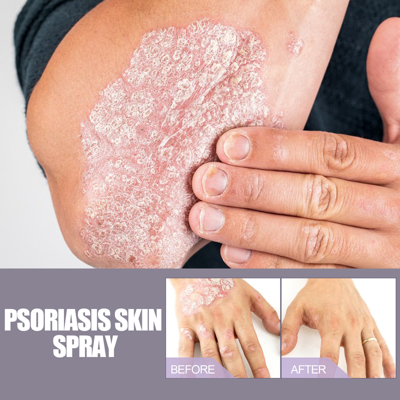 EELHOE hand and foot moss repair relieve itching skin care Knockout spray_voghion.com