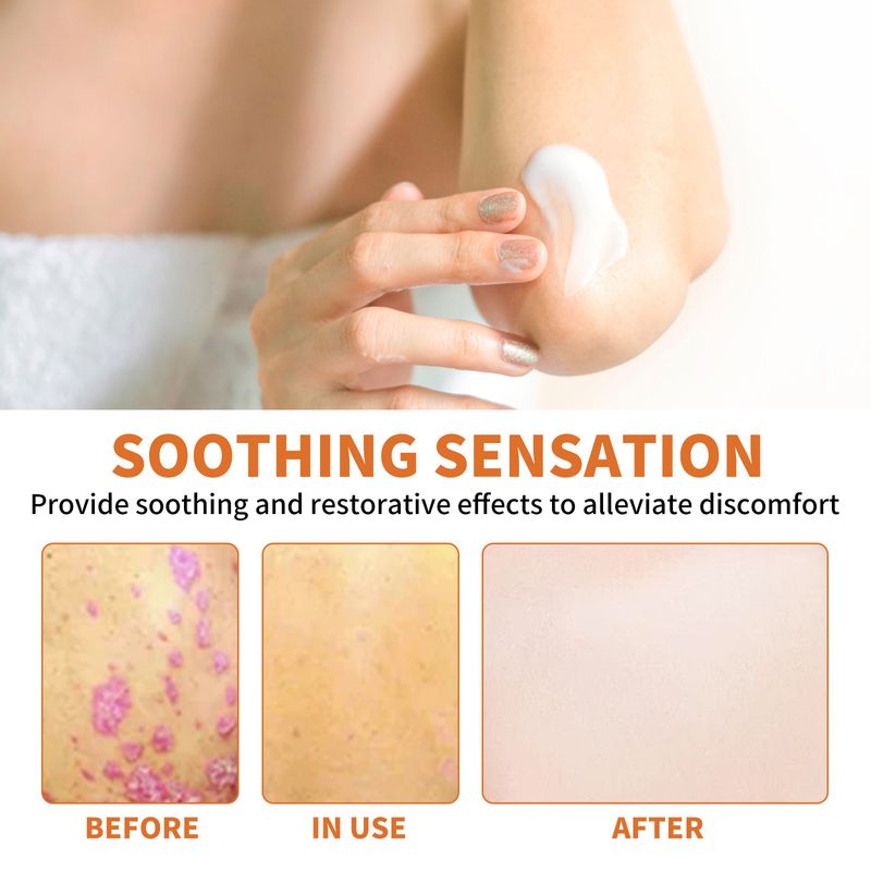 Bee Venom Leather For Redness Itching Of Moss On Hand Foot Moisturizing And Smooth Skin Care Cream_voghion.com