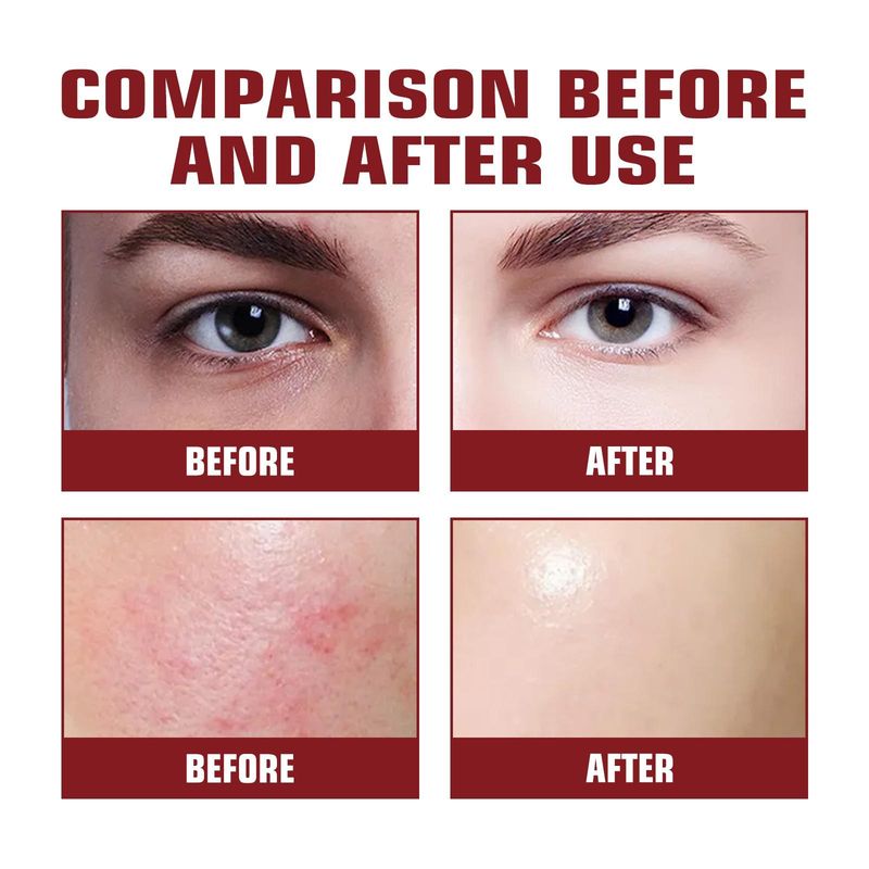 Hoygi-kasvovesi, herkät huokoset, kosteuttava, pehmentävä, ärtynyttä ihoa poistava, finnien poistoon tarkoitettu_voghion.com