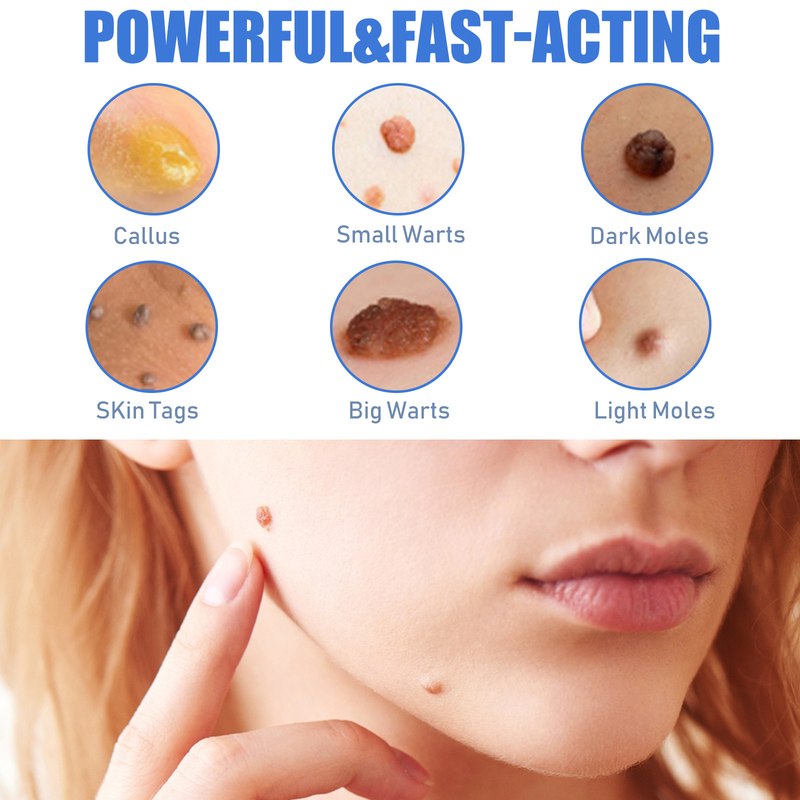 South Moon for hand, foot, facial skin, underarm flesh particles, neck filiform smoothing, flat wart cream_voghion.com