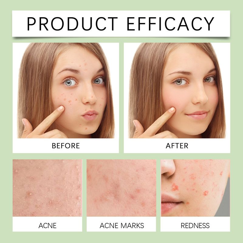 OUHOE Anti-Acne Patch, Gentle Cleansing Helps Relieve Facial Blemishes Appearance Concealer Breathable Facial Care Patch_voghion.com