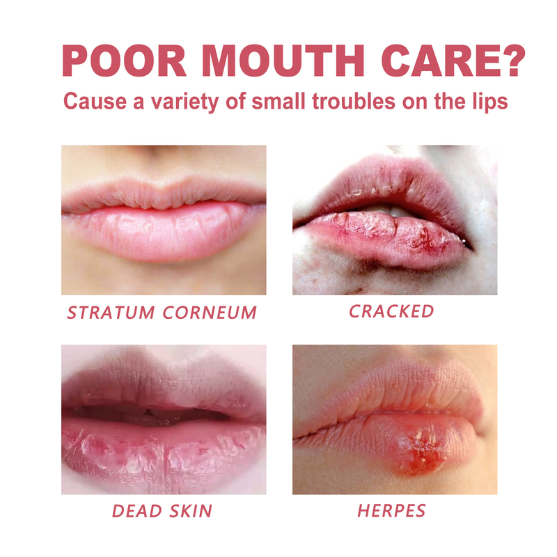 EELHOE lip care oil, lighten lip lines, repair lip periphery particles, prevent dryness, moisturize lip care oil_voghion.com