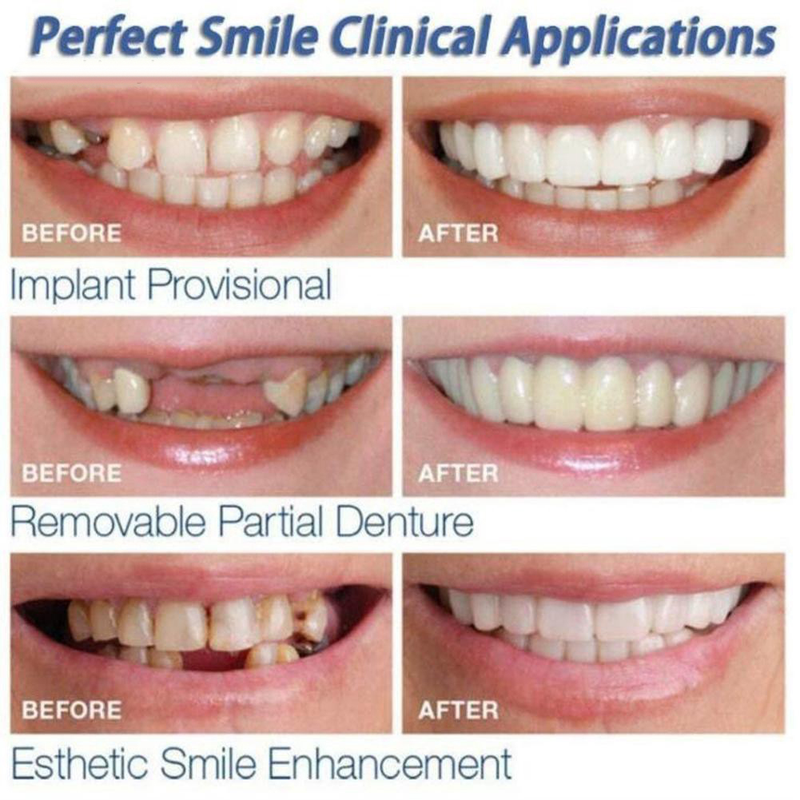 BeautyLife 2st Silikonsimulering Övre Botten Tandprotes Whitening Tandskydd_voghion.com