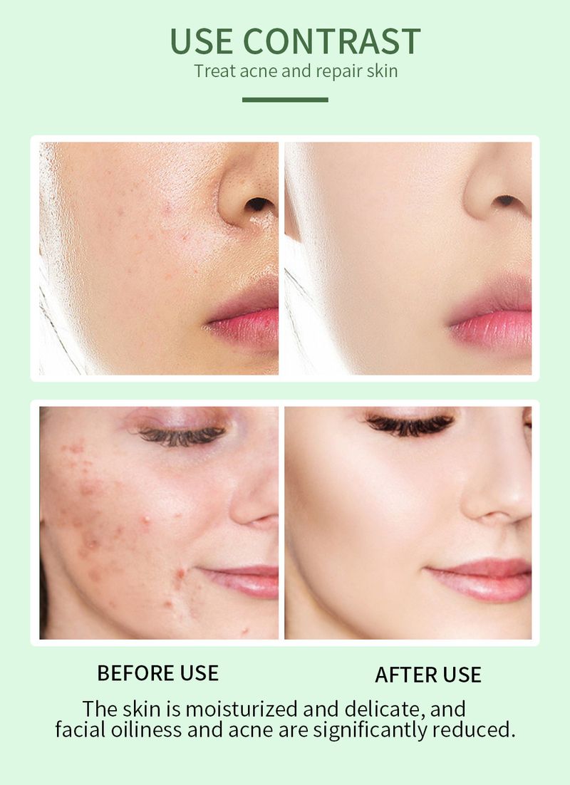 Anti-Akne-Serum, Essenz zur Behandlung von Akne, Pickeln und verstopften Poren – 30 ml_voghion.com