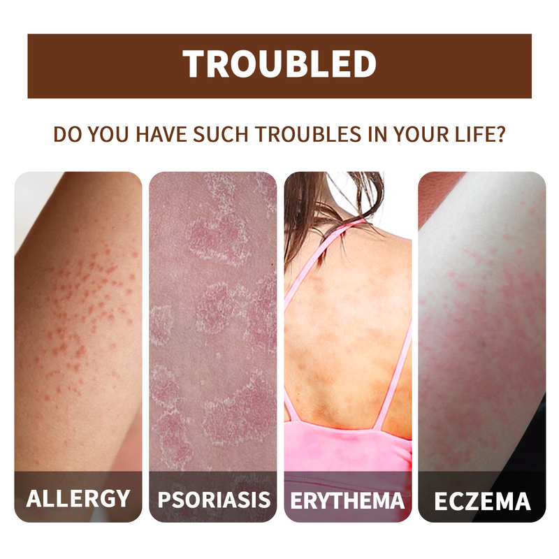 Skin Moss Beautiful Repair Essential Relieve Skin Itch, Stop Itch, Swelling, Hand and Foot Moss External Care Essentia_voghion.com