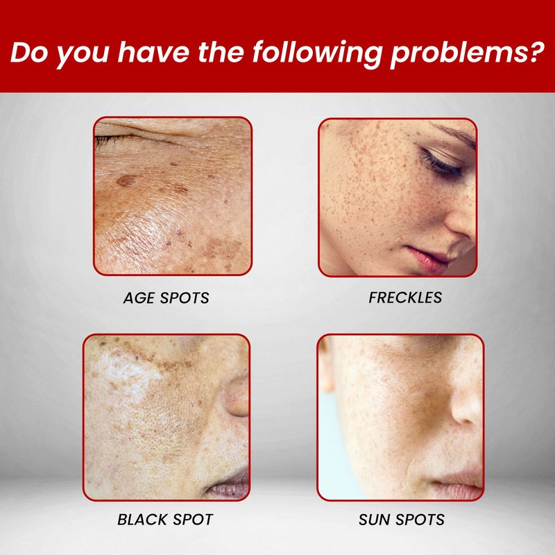 OUHOE Black Spot Removing Cream poistaa suolaa kasvojen juonteista ja finneistä, melaniinista, kosteuttaa, valkaisee ja kosteuttaa ihoa._voghion.com