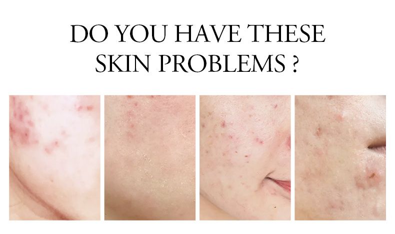 Trattamenti e maschere Crema anti-acne all'aloe vera 20 g Prodotti idratanti per la cura della pelle Confezione in inglese_voghion.com