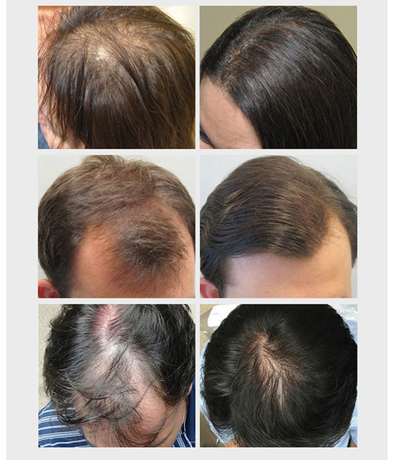 Ingwer-Haarwuchsspray-Produkte, natürliches Anti-Haarausfall-Serum, verhindern Haarausfall, Behandlung, schnelles Wachstum, nähren geschädigtes Haar_voghion.com