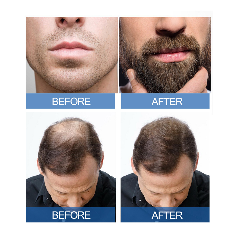 East Moon Loss Prevention Bartpflegekonzentrat für Männer für dickes und festigendes Haar_voghion.com
