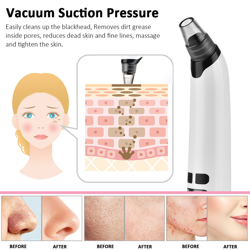 Blackhead Suction Tool, Removal And Heating Beauty Device, Facial Pore Blackhead Remover 2025_voghion.com