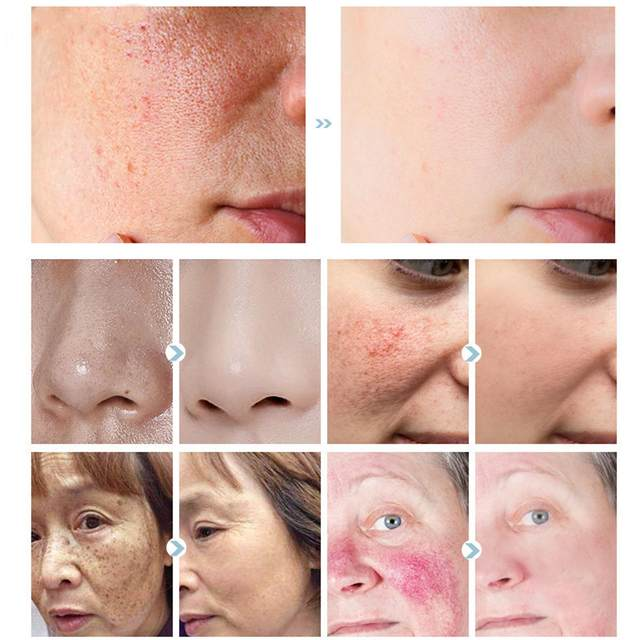Pore Shrinking Serum Salisylsyre Frukt Acid Essence Glatte porer Anti Aldring Bghten Whitening Fuktighetsgivende hudpleieprodukt 30ml_voghion.com