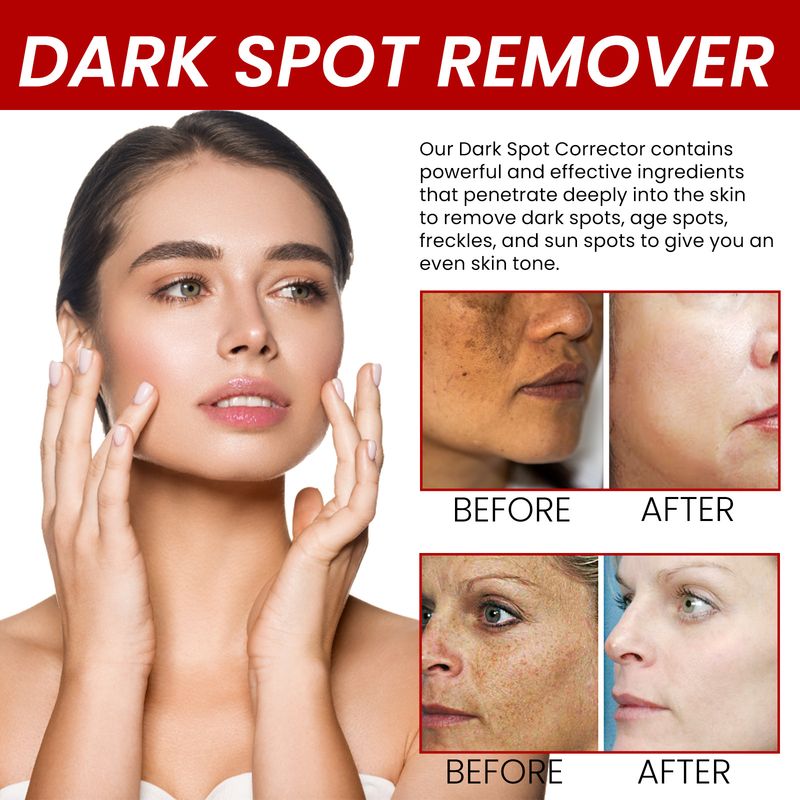 OUHOE Black Spot Removing Cream poistaa suolaa kasvojen juonteista ja finneistä, melaniinista, kosteuttaa, valkaisee ja kosteuttaa ihoa._voghion.com