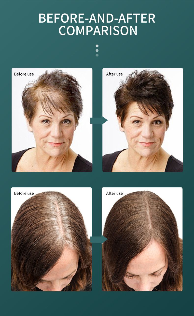 30 ml Melotizhi-Öl für Haarwachstum, Hautpflege, Bio-Öle, natürliches Öl gegen Haarausfall, stimuliert das Haarwachstum, Kopfhautmassagegerät, Aromatherapie_voghion.com