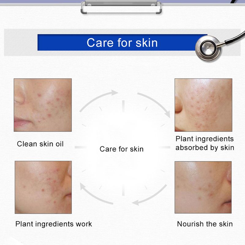 30 g Acne Comedo Pimples noņemšanas poru samazinošs mitrinošs ādas kopšanas krēms_voghion.com