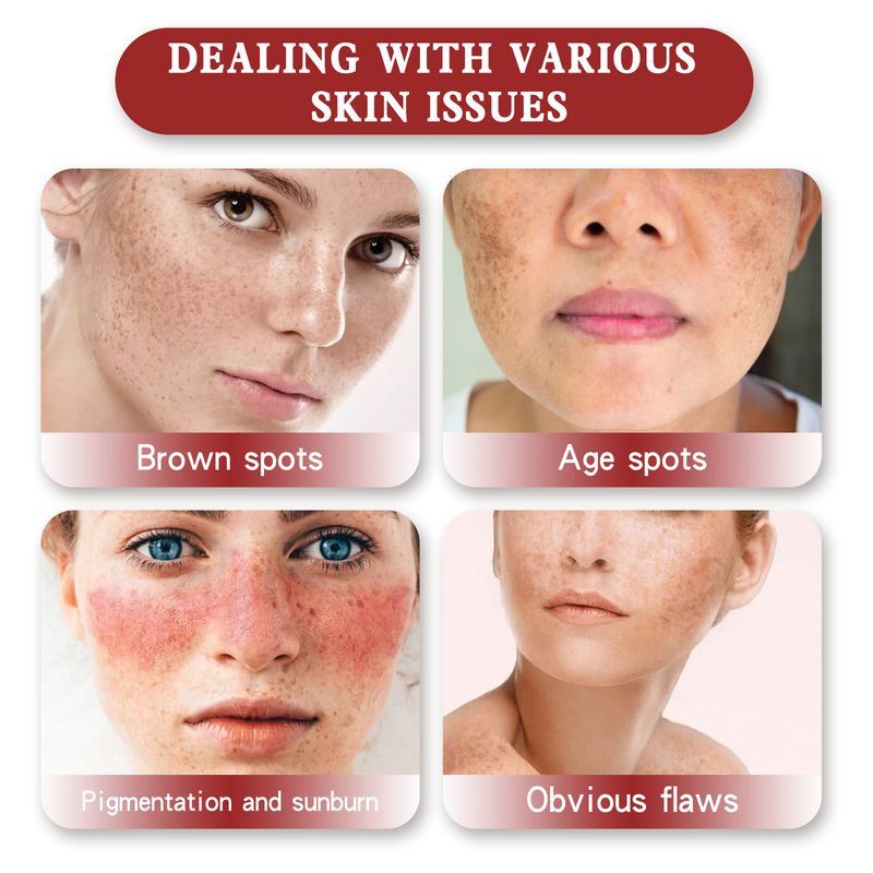 Crema blanqueadora de manchas EELHOE para reparar cicatrices de acné, reducir la opacidad, atenuar manchas, hidratar, nutrir y reafirmar._voghion.com