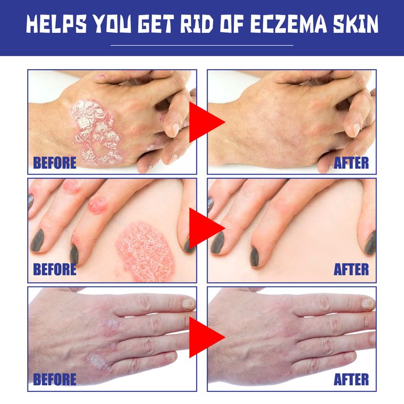 2025 Calfskin Soothing Spray Skin Hand Foot Moss Itching And Swelling Care Spray_voghion.com