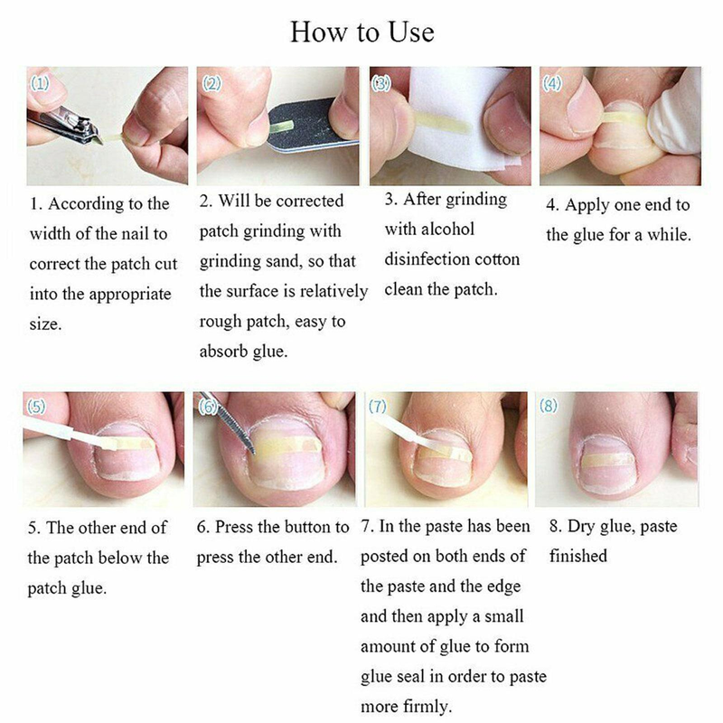 10 pièces/ensemble ongle incarné pince à redresser Patch élastique pince à redresser orthèse incurvée ongles Correction élastique autocollant_voghion.com