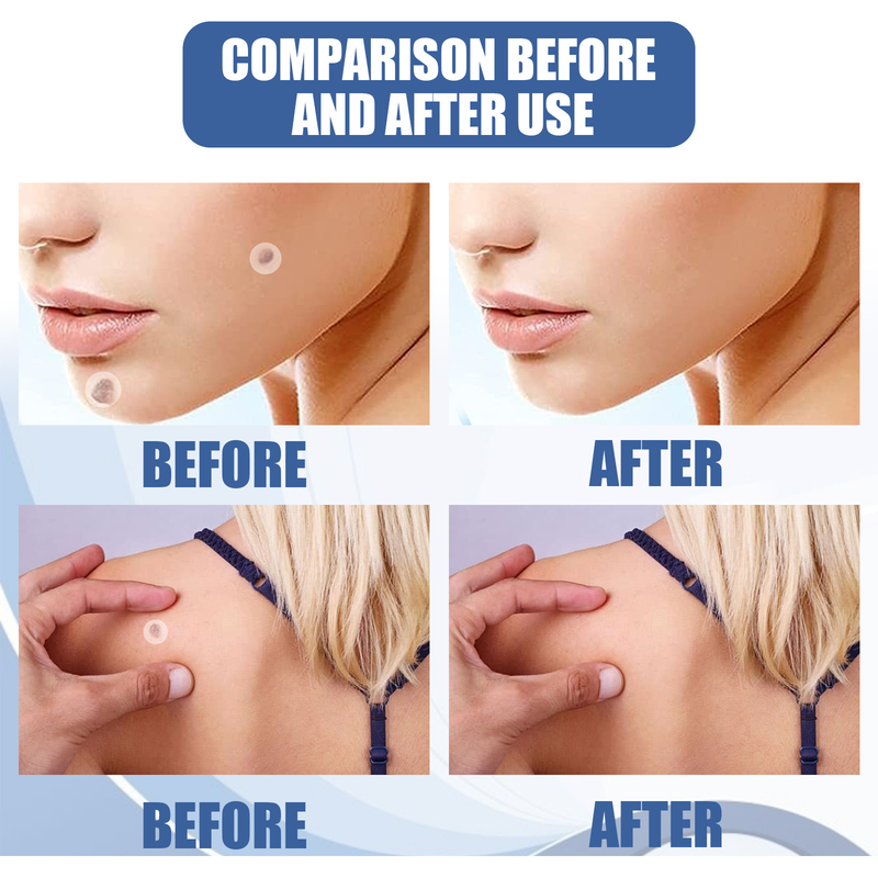 eelhoe 144ks náplast proti bradavicím, kožní vláknité bradavice, bradavice, kuří oka, masitá znaménka, černá znaménka, čistící a pečující náplast proti bradavicím_voghion.com