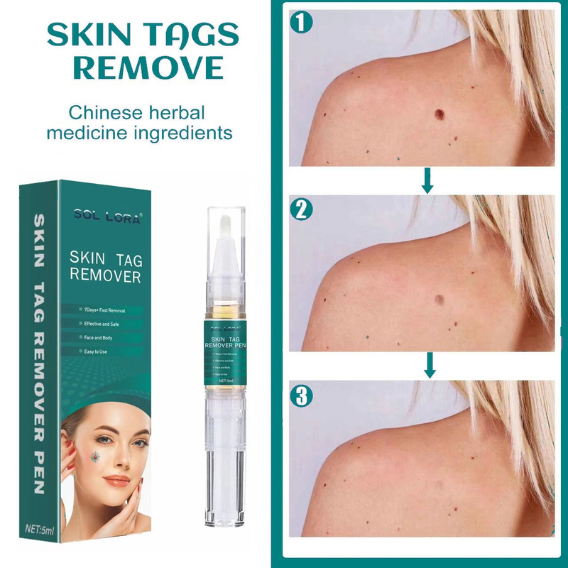 SOL LORA Pen Cream flat specially sharp Ke warts, You Ping Liquid for removing warts_voghion.com