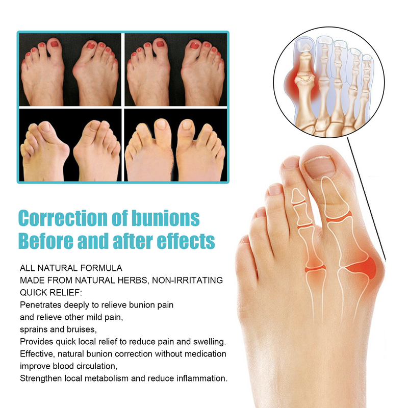 Patch per borsite Moon South per la correzione del pollice valgo e il sollievo del gonfiore e del dolore del piede Patch per la cura delle erbe_voghion.com