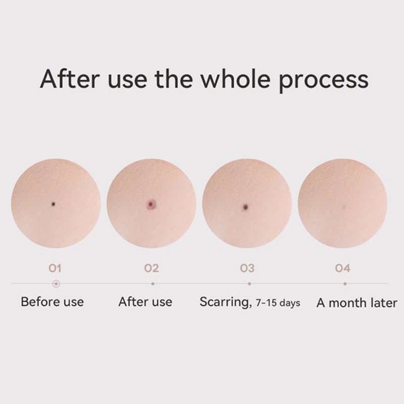 New 15 grade beauty for removing moles, warts, and freckles. Home mole scanning pen with LED display lighting_voghion.com