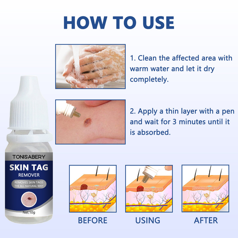 New Skin Tag Remove Wart Treatment_voghion.com