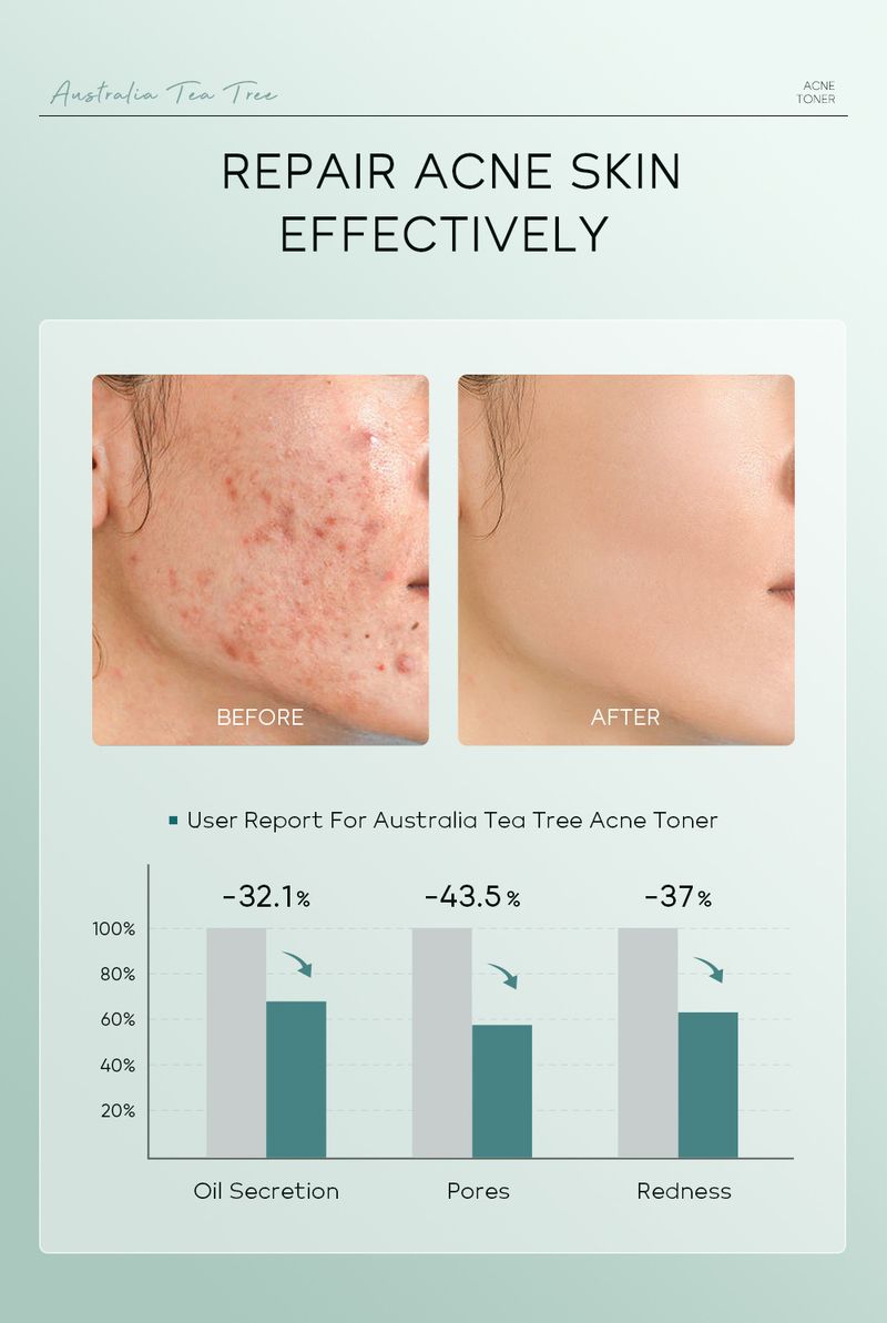 Toners Tea Tree Anti Acne Toner 100ml Hydrating Moisturizing Skin Care Products_voghion.com